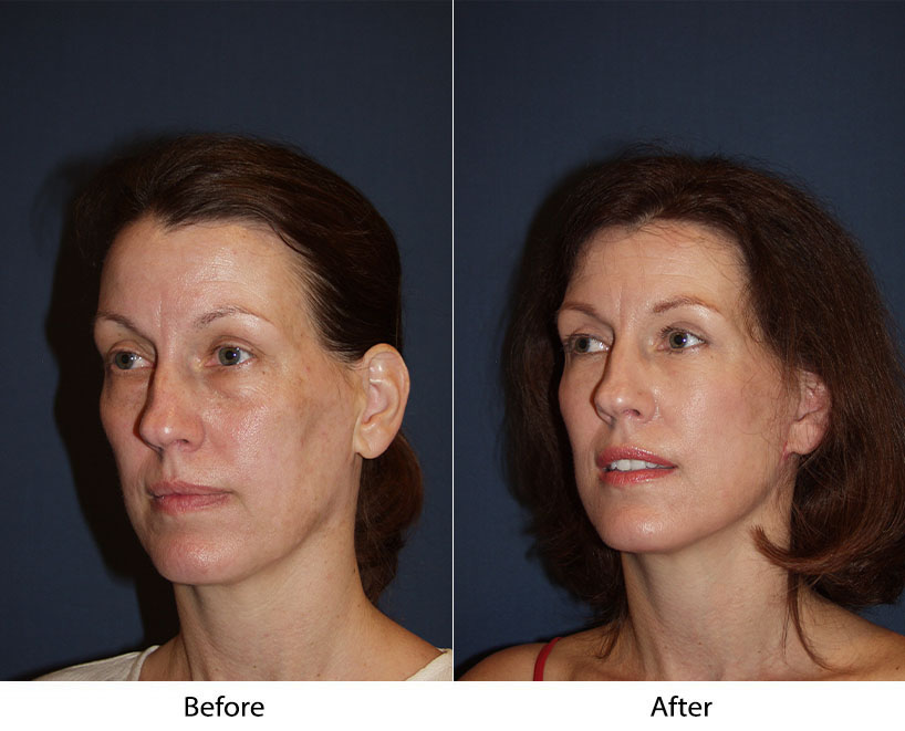 How a SOOF lift blepharoplasty can help you look younger