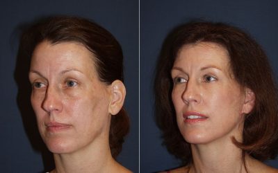 SOOF lift blepharoplasty can make you look younger