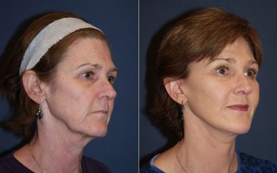 Brow lift surgery help meet your facial appearance goals