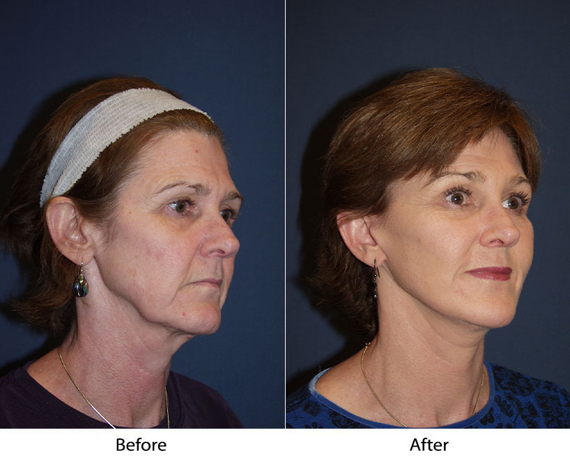 Brow lift surgery help meet your facial appearance goals