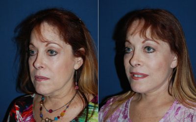 Soof Lift Blepharoplasty surgeon in Charlotte explains facts about the procedure