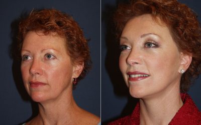 Improve eyes with SOOF lift blepharoplasty by Charlotte’s best facial plastic surgeon